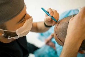 Hair transplant in Sonipat